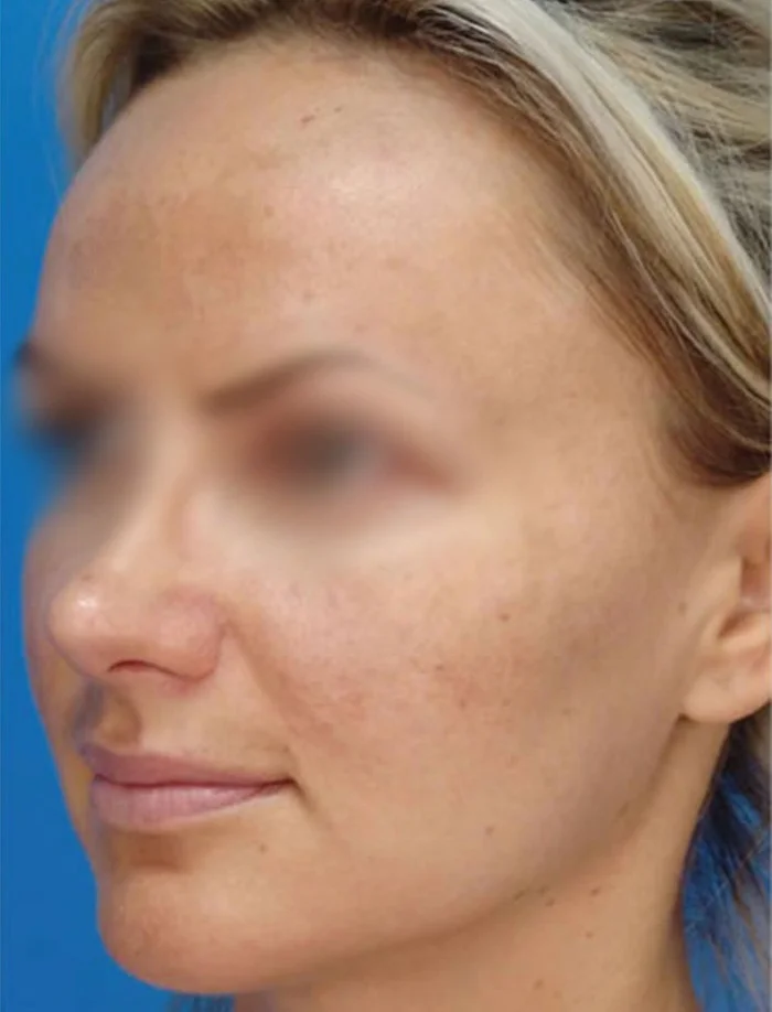 Posle laserskog karbonskog pilinga