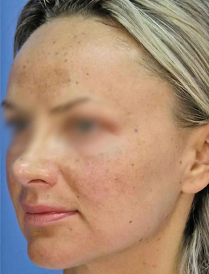 Pre laserskog karbonskog pilinga