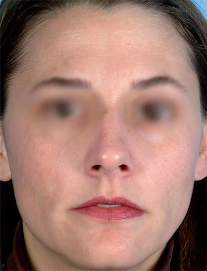 Posle laserskog karbonskog pilinga