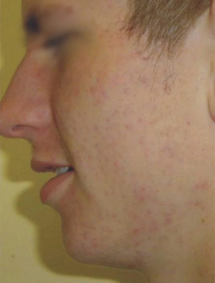 Posle laserskog karbonskog pilinga