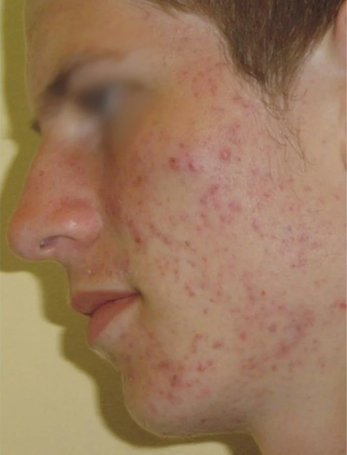 Pre laserskog karbonskog pilinga