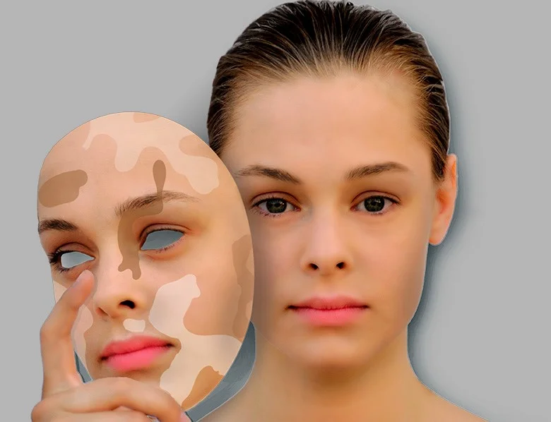 Depigmentacija laserom