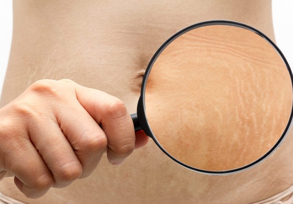 Nehirurško uklanjanje strija u Vita Elos-u